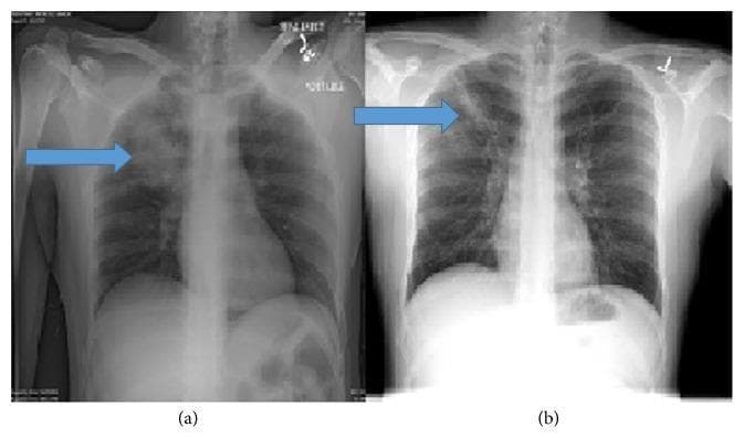 This diagnostic image is a side-by-side comparison of two posterior-anterior (PA) chest X-rays (CXR) illustrating the progression and resolution of lobar pneumonia. Image (a), labeled as the admission radiograph, demonstrates a dense, homogeneous area of increased radiopacity in the right upper lobe, consistent with acute consolidation. This finding obscures local vascular markings and is sharply demarcated inferiorly by the minor fissure. Blue arrows indicate the primary pathology. Image (b) shows the same patient at a 2-month follow-up. There is a significant reduction in the consolidation density, which has been replaced by linear opacities and reticular markings suggestive of residual pulmonary scarring and fibrosis. The lung parenchyma in (b) shows improved lucency compared to (a), indicating clinical improvement. This comparison is educational for identifying radiographic features of airspace disease, the characteristic distribution of right upper lobe consolidation, and the subsequent stages of radiographic resolution in bacterial or atypical (e.g., Mycoplasma pneumoniae) pneumonia.