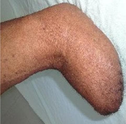 This clinical photograph displays a residual limb following a transradial (below-elbow) amputation. The stump is depicted in a flexed position, showing a healthy, well-healed surgical outcome. The residual limb exhibits a cylindrical shape with slight distal tapering and a smooth, rounded distal end, indicating appropriate soft tissue coverage and successful maturation of the stump. The skin is medium brown with a visible, slightly rough texture and distributed hair follicles. There are sporadic, small hyperpigmented macules across the surface, but no signs of inflammation, ulceration, or dehiscence at the distal end. This image serves as an educational example of a healthy, mature residual limb suitable for prosthetic fitting and weight-bearing preparation in the field of physical medicine and rehabilitation.