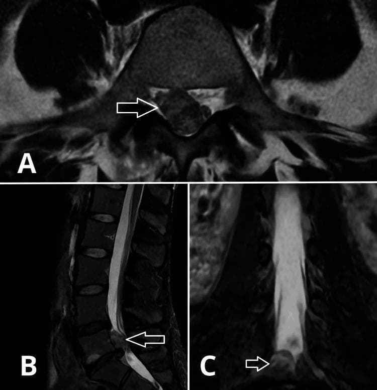 Multi-planar MRI images of the lumbar spine demonstrating a significant disc herniation at the L5-S1 level. The composite image includes axial (A), sagittal (B), and coronal (C) views. In all three projections, a large, hypointense (dark-gray) mass—indicated by white arrows—represents a cranially migrated sequestered disc fragment. In the axial view (A), the herniation is situated in the right paracentral/subarticular zone, causing significant compression of the thecal sac and narrowing of the right lateral recess. The sagittal view (B) highlights the cranial migration of the disc material posterior to the L5 vertebral body. The coronal view (C) shows the mass projecting from the right side into the spinal canal. This imaging is characteristic of lumbar radiculopathy secondary to disc sequestration. The T2-weighted appearance (high signal in the CSF) provides contrast against the low-signal disc fragment, emphasizing the degree of canal stenosis and neural element compression.