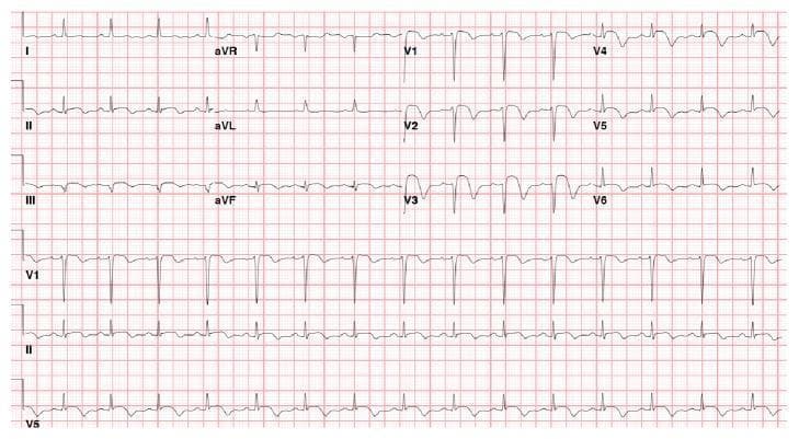 A 12-lead electrocardiogram (ECG) recorded on standard grid paper, demonstrating acute diagnostic findings consistent with an ST-elevation myocardial infarction (STEMI). The tracing shows normal sinus rhythm with a physiological heart rate. The primary pathology is significant ST-segment elevation (STE) visible in the precordial leads, most prominently in V2, V3, and V4, measuring approximately 2–3 mm above the isoelectric baseline. These anterior leads also display upright, peaked T waves associated with the acute ST elevation. The QRS complexes maintain relatively normal duration and morphology without evidence of bundle branch blocks. These findings are clinically diagnostic of acute myocardial injury in the territory of the left anterior descending (LAD) coronary artery, often indicating complications such as acute stent thrombosis or new-onset occlusion in the anteroseptal and apical regions. The limb leads (I, II, III, aVR, aVL, aVF) show relatively stable baselines compared to the precordial changes. This ECG serves as a critical educational tool for identifying hyperacute ischemic changes in a post-intervention clinical context.