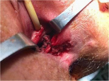 This clinical photograph captures a surgical field during a complex gynecological and proctological reconstruction for Crohn's disease-related fistulae. The image illustrates the 'final set-up' of a multi-step procedure involving the repair of a rectovaginal fistula and a longitudinal vaginal septum. Key anatomical features visible include the perineovaginal tract, which has been 'laid open' to expose underlying structures. Central to the operative site is the bulbocavernous muscle, carefully isolated and transposed as a Martius flap to reinforce the fistula repair. The vaginal mucosa is shown closed with meticulously placed interrupted absorbable sutures following the sectioning of the longitudinal vaginal septum. Surgical retractors are positioned to provide visualization of the deep pelvic tissues and the reinforced rectovaginal septum. This image serves as an educational resource for pelvic floor reconstruction, demonstrating tissue transposition and the management of congenital anomalies (septate vagina) in the context of chronic inflammatory bowel disease complications.