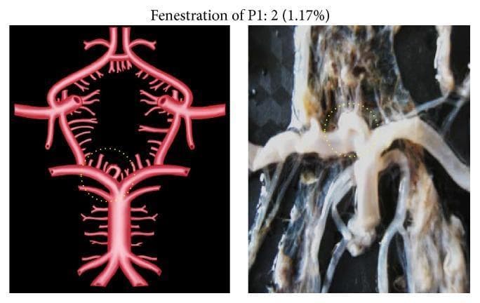 This composite image consists of an anatomical diagram and a corresponding gross clinical photograph illustrating a morphological variation of the Circle of Willis. The content focuses on the P1 segment of the posterior cerebral artery (PCA). The left panel is a schematic diagram of the cerebral arterial circle, highlighting a vascular fenestration within the right P1 segment, demarcated by a yellow dotted circle. The right panel is a macro-photograph of a cadaveric brain dissection showing the same anatomical region. In both images, the P1 segment exhibits a characteristic splitting into two distinct longitudinal channels that rejoin distally, creating a window-like defect rather than a single continuous lumen. This finding represents a P1 fenestration, an uncommon congenital vascular anomaly. Key structures visible include the basilar artery bifurcation, the superior cerebellar arteries, and the junction with the posterior communicating artery. This material is designed for neuroanatomy and neuroradiology education, specifically for understanding normal anatomical variants and potential sites for aneurysm formation.