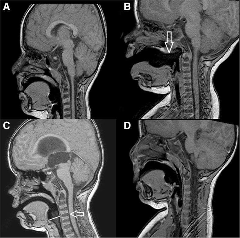 This set of four sagittal T1-weighted MRI images (A, B, C, and D) illustrates the radiological evaluation of laryngeal mask airway (LMA) placement in pediatric patients. Image A displays the radiologically correct position, with the LMA tip seated in the hypopharynx and the proximal cuff aligned with the C1-C2 cervical vertebrae. In contrast, images B, C, and D demonstrate different types of malposition. Image B (Malposition A) shows the mask displaced anteriorly, pointed out by a white arrow, indicating it is outside the hypopharynx. Image C (Malposition B) shows the proximal cuff positioned inferiorly to the C1-C2 level, with a white arrow highlighting the vertebral misalignment. Image D (Malposition C) presents a malposition characterized by spatial measurement discrepancies, where the distance from the proximal cuff to the aditus laryngis (10.9 mm) exceeds the distance from the distal cuff to the aditus laryngis (6.4 mm). These images serve as an educational tool for anesthesiologists to identify anatomical landmarks such as the soft palate, tongue base, and cervical spine relative to supraglottic airway devices.