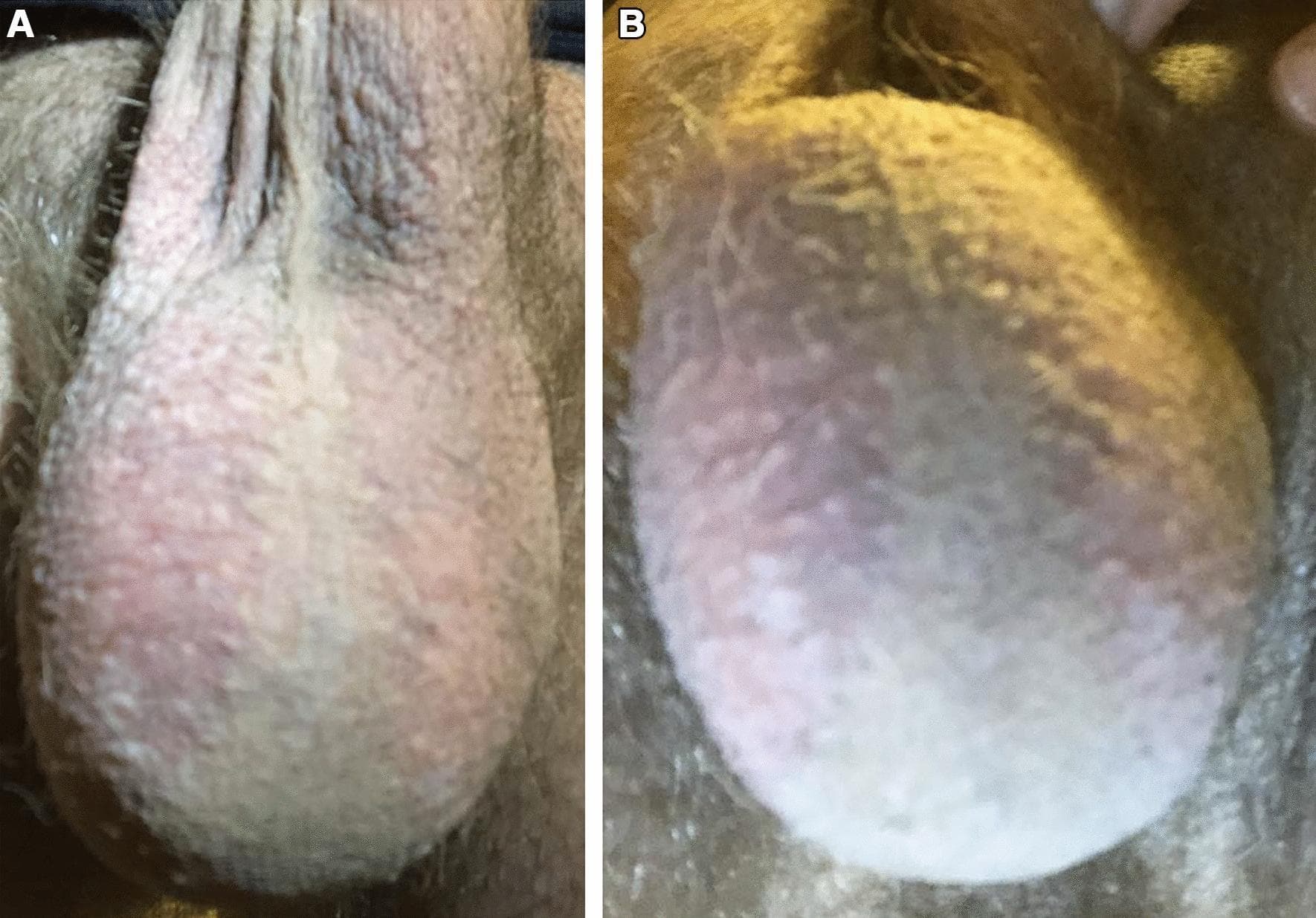 Two-panel clinical photograph (A and B) of the male external genitalia illustrating localized cutaneous erythema of the scrotum. Image A depicts the anterior scrotum and ventral penile shaft, showing well-demarcated, bilateral erythema. A key clinical finding is the distinct sparing of the vertical scrotal midline (raphe) where hair follicles are absent, while the erythematous area corresponds precisely to the distribution of scrotal hair follicles. Image B shows the underside of the scrotum from an inferior angle, demonstrating that the skin in this region is unaffected, retaining a normal skin tone and texture. There are no visible signs of ulceration, induration, edema, or pustules. The presentation is characteristic of a follicle-associated dermatosis or an atypical inflammatory response, such as 'Red Scrotum Syndrome' or a localized folliculitis, emphasizing the diagnostic importance of topographical distribution and the sparing of hairless anatomical regions in dermatology.