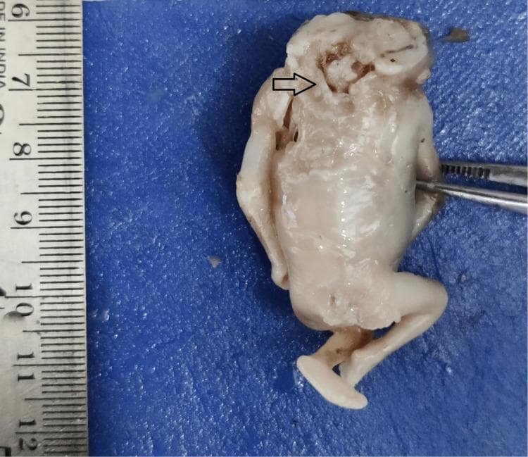 This clinical photograph shows a human fetal specimen demonstrating anencephaly, a severe open neural tube defect. The image highlights a significant malformation of the cephalic region characterized by the absence of a major portion of the brain (forebrain and cerebral hemispheres) and the overlying cranial vault (acrania). An arrow points to the area of the defect where disorganized neural tissue, often referred to as the area cerebrovasculosa, is exposed. In contrast to the severe cranial deformity, the rest of the fetal anatomy, including the torso, upper limbs, and lower limbs with visible feet, appears relatively well-developed and intact. A ruler is positioned to the left for scale, and surgical forceps are visible on the right, indicating a pathological or embryological examination. This specimen serves as a classic educational example of a failure of the neural tube to close at the cranial end during early embryonic development.
