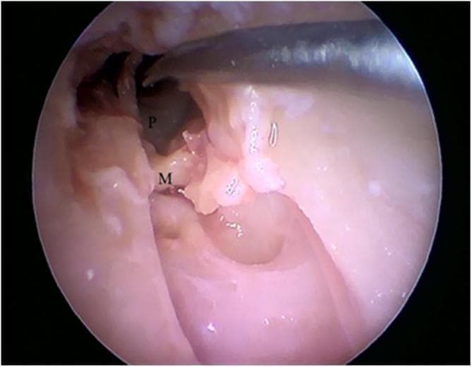 This clinical endoscopic photograph captures an intraoperative view of a middle ear dissection, specifically identifying the anatomical relationship between the ossicles and the medial wall. The promontory (labeled 'P'), which corresponds to the basal turn of the cochlea, is visible as a darker, rounded bony prominence on the medial wall of the tympanic cavity. The malleus (labeled 'M') is shown in a state of detachment, displaced from its normal anatomical position relative to the tympanic membrane and other ossicles. A surgical instrument is visible at the top of the frame, manipulating the tissue to expose the middle ear space. The surrounding mucosa appears moist and light pink, with some fibrous tissue remnants near the tympanic annulus. This image serves as an educational tool for understanding otologic surgical anatomy and the visual identification of middle ear landmarks during endoscopic procedures.