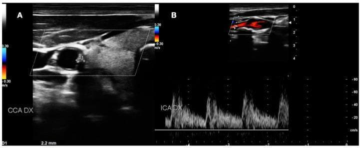 This composite diagnostic image displays Duplex Ultrasound (DUS) scans of the right carotid artery system, illustrating carotid atherosclerosis. Panel A shows a B-mode cross-sectional view of the right common carotid artery (CCA DX) highlighting a medium-grade atherosclerotic plaque. The plaque exhibits mixed echogenicity with hypoechoic regions and is seen protruding into the vessel lumen; calipers (D1) measure an intima-media thickness (IMT) or plaque height of 2.2 mm. Panel B demonstrates the right internal carotid artery (ICA DX) using color Doppler and spectral Doppler analysis. The color Doppler identifies blood flow velocity and direction, with red and blue coding indicating flow towards and away from the transducer at a scale of 0.30 m/s. The corresponding spectral Doppler waveform below provides a hemodynamic assessment, showing a characteristic pulsatile arterial flow pattern over time. This visual material is used in cardiovascular medicine to evaluate the morphology, grade, and hemodynamic impact of carotid artery stenosis.