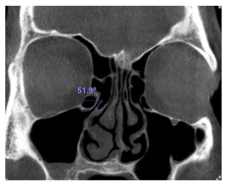 This diagnostic image is a coronal Computed Tomography (CT) scan of the paranasal sinuses and nasal cavity using a bone window setting. The view displays key sinonasal anatomy, including the maxillary sinuses, the ethmoid air cells, the nasal septum, and the inferior and middle nasal conchae (turbinates). The image specifically illustrates the morphometry of the ostiomeatal complex. An overlaid blue line measures the inclination of the uncinate process on the patient's right side. The measurement shows an angle of 51.9 degrees, calculated between a horizontal reference line originating from the superior edge of the uncinate process and its superior border. This anatomical assessment is clinically relevant for evaluating the patency of the infundibulum and planning functional endoscopic sinus surgery (FESS), as the uncinate process orientation can influence the drainage pathway of the anterior ethmoid and maxillary sinuses.