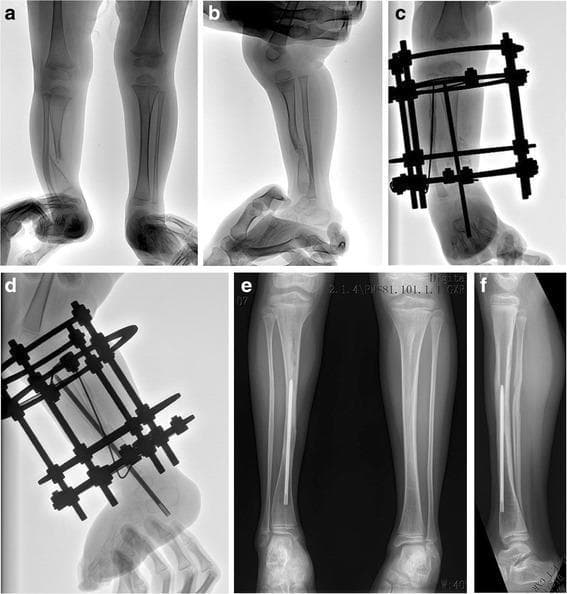 A series of weight-bearing and non-weight-bearing radiographs showing the surgical management of Crawford type IV congenital pseudarthrosis of the tibia (CPT) in a pediatric patient. Panels (a) and (b) represent the preoperative state, showing significant anterolateral bowing and mid-diaphyseal pseudarthrosis of the tibia with an intact fibula. Panels (c) and (d) are postoperative images at 2 months, demonstrating an Ilizarov circular external fixator applied for stability and compression; the frame consists of rings connected by threaded rods and tensioned Kirschner wires. An intramedullary rod is also visible. Panels (e) and (f) show the long-term follow-up at 5.4 years post-operation, highlighting successful solid bony union, restoration of anatomical alignment, and a persistent intramedullary rod. The images demonstrate the absence of ankle valgus or significant limb-length discrepancy (LLD), marking effective treatment of pediatric tibial dysplasia through combined internal fixation and circular external distraction/compression osteogenesis.