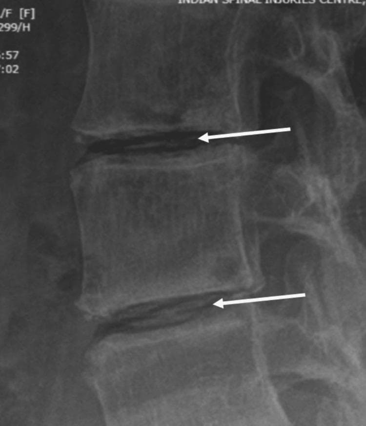 This lateral lumbar spine radiograph demonstrates significant intradiscal calcification, a hallmark finding in Alkaptonuria (ochronosis). The calcifications appear as opaque, oblong, wafer-like densities within the intervertebral disc spaces, specifically highlighted by white arrows. Accompanying these findings are generalized degenerative changes including narrowing of the disc spaces and vertebral endplate sclerosis, which appears as increased radiodensity at the superior and inferior margins of the vertebral bodies. There is also evidence of reduced bone density (osteopenia). These visual features are characteristic of ochronotic spondylosis, where homogentisic acid deposition leads to rapid disc degeneration and secondary calcification. This diagnostic image is intended for intermediate to advanced medical education, illustrating the differential diagnosis for spinal calcification beyond standard degenerative disc disease or ankylosing spondylitis.