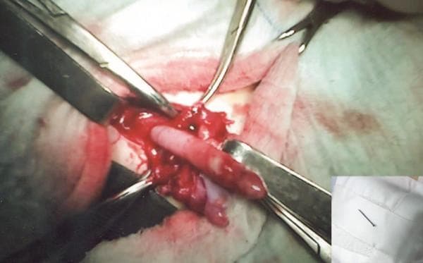 This clinical photograph captures an intraoperative view of an inflamed vermiform appendix during a surgical exploration for an Amyand's hernia. The primary image shows a red, swollen, and hyperemic appendix being retracted with surgical instruments. A visible perforation is noted at the distal apex of the appendix, caused by an ingested foreign body. The surrounding hernia sac contains serous-purulent exudate and hemorrhagic fluid, indicative of acute inflammation and localized infection. An inset photograph in the bottom-right corner displays the extracted metallic domestic pin against a white surgical cloth. The image demonstrates a rare surgical complication where a foreign body causes perforated appendicitis within a right inguinal hernia sac. Educational focus includes surgical anatomy of the inguinal canal, identification of acute appendicitis during hernioplasty, and management of foreign body-induced visceral perforation.
