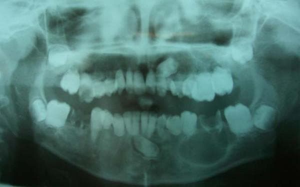 A panoramic dental radiograph (orthopantomogram) of a pediatric patient illustrating hallmarks of Dentin Dysplasia Type I (DD-I). The imaging shows a generalized lack of root development across the primary and permanent dentition, with teeth exhibiting either extremely short, blunted roots or a complete absence of root structure. Multiple teeth present with large radiolucent areas consistent with extensive dental caries. Notably, there is a large, well-defined, round unilocular radiolucency associated with the apex of the mandibular left first permanent molar, suggestive of a radicular cyst or apical inflammatory lesion. Furthermore, the left maxillary and mandibular canines are horizontally impacted within the alveolar bone. The overall presentation highlights the characteristic 'rootless teeth' appearance and associated secondary pathologies such as premature mobility, periapical lesions, and tooth impaction common in hereditary dentin disorders.