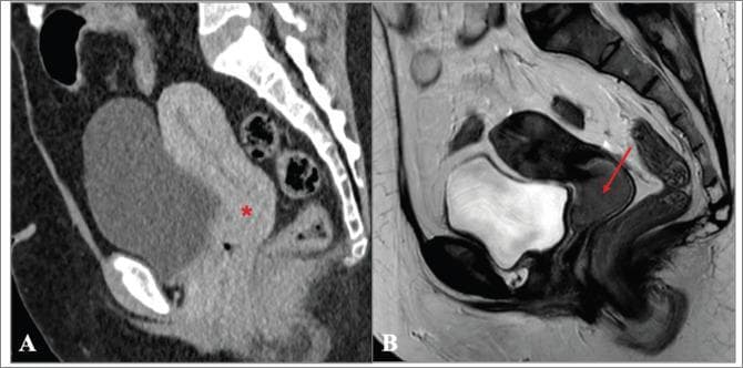 A side-by-side comparison of diagnostic images in the sagittal plane demonstrating the superior soft-tissue contrast of MRI over CT for cervical cancer staging. Image (A) is a sagittal CT of the pelvis in the venous phase where the cervix appears unremarkable (marked with an asterisk), failing to clearly delineate a primary tumor. Image (B) is a T2-weighted sagittal MRI of the same patient performed three months later. The MRI reveals a distinct, intermediate-to-low signal intensity ovoid mass (indicated by a red arrow) within the cervix, measuring approximately 3.5 cm. The tumor is well-visualized against the high signal intensity of the normal cervical stroma, illustrating FIGO stage IB2 cervical carcinoma. This comparison highlights the clinical importance of T2-weighted MRI in gynecological oncology for accurate tumor localization, measurement of the greatest axis, and locoregional staging, where CT may lack the necessary resolution to detect early or subtle infiltrative lesions.