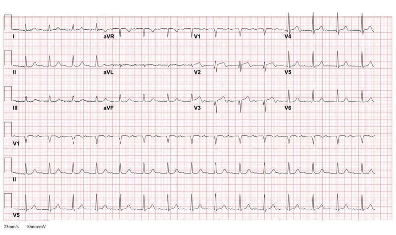 A 12-lead electrocardiogram (ECG) demonstrating the classic 'Type A' Wellens' Syndrome pattern. The recording shows a regular rhythm with normal QRS complexes; however, there is a pathognomonic T-wave morphology in the precordial leads, specifically V2 and V3. These leads exhibit biphasic T-waves characterized by an initial shallow positive deflection followed by a deep, terminal negative deflection. The terminal inversion is more prominent in amplitude than the initial upward phase. Such findings in the context of clinical stability are highly specific for critical stenosis of the proximal left anterior descending (LAD) coronary artery. The ECG also includes standard limb leads (I, II, III), augmented limb leads (aVR, aVL, aVF), and the full precordial series (V1-V6), with rhythm strips for V1, II, and V5 at the bottom. The paper speed is noted at 25mm/s with a sensitivity of 10mm/mV, providing a standard diagnostic reference for ischemic heart disease and acute coronary syndrome (ACS) evaluation.