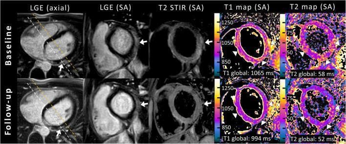 A multi-panel cardiac magnetic resonance imaging (MRI) study demonstrating acute myocarditis at baseline and follow-up (2 months) in a pediatric patient. The top row (baseline) shows subepicardial late gadolinium enhancement (LGE) in the basal lateral wall across axial and short-axis (SA) views, along with focal myocardial edema indicated by hyperintensity on T2 STIR (arrows). Quantitative T1 and T2 mapping displays elevated global relaxation times (T1: 1065 ms; T2: 58 ms) with arrowheads highlighting diffuse alterations in the septal and inferior walls. The bottom row (follow-up) illustrates clinical recovery: LGE intensity in the basal lateral wall is significantly reduced, T2 STIR signal has normalized indicating resolution of focal edema, and quantitative mapping shows a decrease in T1 (994 ms) and T2 (52 ms) values back to normal ranges. This comparison highlights the diagnostic value of both qualitative LGE/T2 STIR imaging and quantitative mapping according to the 2018 Lake Louise criteria for monitoring myocarditis progression and recovery.