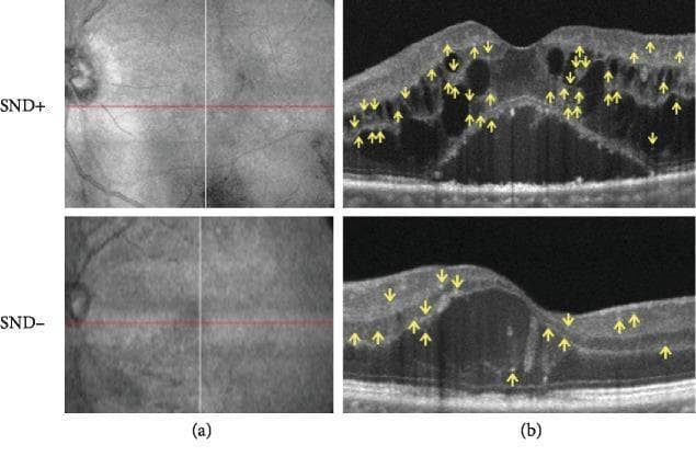 Optical coherence tomography (OCT) imaging comparison of diabetic macular edema (DME) categorized by subfoveal neuroretinal detachment (SND) status. Column (a) presents infrared (IR) reflectance fundus images with a horizontal red reference line indicating the B-scan acquisition plane. Column (b) shows corresponding cross-sectional OCT B-scans for SND+ (top) and SND- (bottom) clinical presentations. The SND+ scan demonstrates significant intraretinal pathology, including multiple hyporeflective cystoid spaces indicative of cystoid macular edema (CME) and a large subfoveal fluid collection (SND) separating the neurosensory retina from the retinal pigment epithelium. Yellow arrows highlight numerous hyperreflective retinal spots (HRS) scattered across both the inner and outer retinal layers. In contrast, the SND- B-scan displays retinal thickening and minor architectural disruption but lacks the subfoveal detachment and shows a markedly lower density of HRS. This comparison illustrates the structural biomarkers used to assess inflammatory and vascular components of diabetic retinopathy, with HRS serving as potential indicators of microglial activation and neuroinflammation.