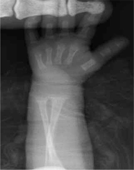 Anteroposterior (AP) pediatric wrist radiograph demonstrating classic radiological signs of rickets, specifically metabolic bone disease of prematurity (MBDP). The primary findings are located at the distal metaphyses of the radius and ulna. These include significant metaphyseal widening (splaying), fraying (loss of sharp cortical definition), and cupping of the metaphyseal margins. The growth plates (physes) appear abnormally widened. The carpal centers are not yet ossified, consistent with neonatal or early infant developmental age. These skeletal changes reflect inadequate mineralization of the osteoid at the zone of provisional calcification. The image serves as a key diagnostic reference for identifying rickets-like changes in a clinical pediatric or neonatal setting.