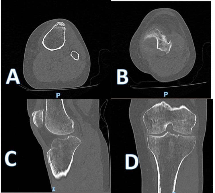 Multi-planar pre-operative Computed Tomography (CT) scan images of a left knee demonstrating complex traumatic fractures. Images A and B (axial views) show a minimally displaced transverse fracture through the inferior aspect of the patella and a comminuted fracture of the proximal tibia with cortical breaching. Image C (sagittal view) highlights an avulsion-type fracture of the tibial tuberosity. Image D (coronal view) reveals a vertical-oblique fracture line extending superiorly toward the tibial plateau, involving the intercondylar notch and causing a depressed fragment of the lateral tibial condyle. This clinical imaging set illustrates a synchronous injury involving both the extensor mechanism (patellar fracture) and the proximal tibial articular surface, specifically a type 4 pattern injury according to clinical classification. The diagnostic imaging is critical for surgical planning of open reduction and internal fixation (ORIF).