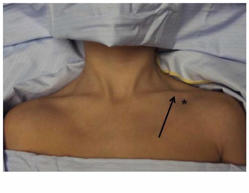 This clinical photograph illustrates the surface anatomy and landmarks for infraclavicular subclavian vein catheterization. The image shows the upper chest and neck of a patient in a supine position, prepped and draped for a sterile procedure. Key anatomical landmarks include the clavicle, sternocleidomastoid muscle, and suprasternal notch. An asterisk marks the needle insertion site, located approximately 1-2 cm inferior and lateral to the junction of the medial one-third and lateral two-thirds of the clavicle. A black arrow indicates the planned trajectory of the needle, aiming medially toward the suprasternal notch and passing immediately beneath the clavicle to access the subclavian vein. This visual guide demonstrates the standard landmark-based approach for central venous access, emphasizing the relationship between bony structures and deep vascular anatomy to minimize risks such as pneumothorax or arterial puncture.