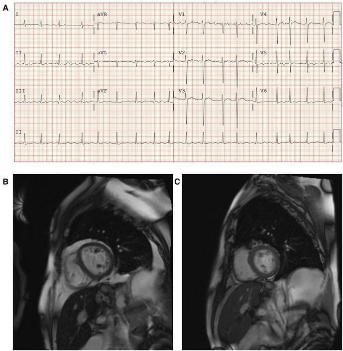 This composite educational graphic illustrates the diagnosis and treatment response of Iron Overload Cardiomyopathy (IOC) in a patient with primary hemochromatosis. Panel A presents a standard twelve-lead electrocardiogram (ECG) showing atrial flutter with a ventricular rate of approximately 105 beats per minute and non-specific T-wave inversions in the lateral leads (V4-V6), indicative of conduction abnormalities. Panels B and C show Cardiac Magnetic Resonance (CMR) short-axis views with T2* mapping for myocardial iron quantification. Panel B (baseline) demonstrates darkened myocardial signal intensity, particularly in the left ventricle, corresponding to moderate iron loading (T2* value of 12–13 ms) and significant hepatic iron overload. Panel C (12-month follow-up) shows the same anatomical view after iron chelation therapy with adjunctive amlodipine. The improved signal intensity in the myocardium (T2* of 26 ms) indicates a successful reduction in iron deposition and restoration of near-normal myocardial tissue characteristics, correlating with improved systolic and diastolic function.