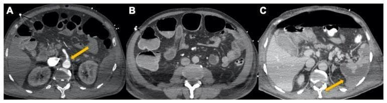 This set of axial contrast-enhanced computed tomography (CECT) scans illustrates severe abdominal vascular and visceral complications associated with COVID-19-related coagulopathy. Image A (arterial phase) shows a partial thrombosis of the superior mesenteric artery (SMA), identified by a yellow arrow indicating an intraluminal filling defect. Image B (venous phase) demonstrates evidence of secondary bowel ischemia, characterized by distended colic loops with air-fluid levels and significant pericolic fat stranding/inflammation. Image C, taken two days later, reveals progressive clinical deterioration with a large pneumoperitoneum (free intraperitoneal air) and multiple wedge-shaped, non-enhancing regions in the spleen consistent with splenic infarcts (yellow arrow). The series demonstrates the progression from mesenteric arterial thrombosis to bowel obstruction, perforation, and multi-organ embolic/ischemic events. These findings serve as a critical educational example of systemic hypercoagulability and its impact on the gastrointestinal and vascular systems in severe viral infections.