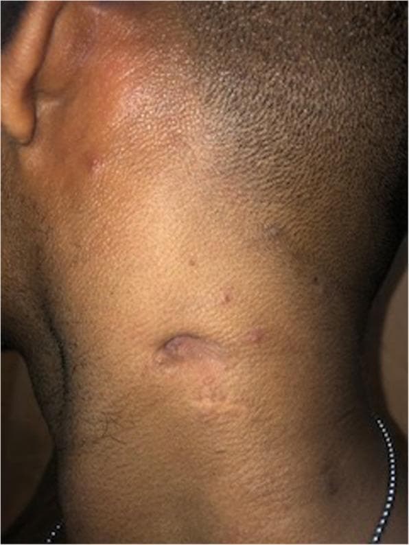This clinical photograph shows a lateral-posterior view of a patient's neck and auricular region, demonstrating the resolution of cervical lymphadenopathy. A prominent, healed scar is visible on the mid-cervical region, likely representing the site of a formerly discharging sinus tract. The scar is elongated and slightly depressed with a hypopigmented, atrophic appearance compared to the surrounding skin. Several small, scattered, erythematous papules and minor irregularities are also visible on the upper neck and near the ear. The underlying lymphadenopathy has clinically resolved, as evidenced by the lack of visible swelling or active drainage. This image illustrates the skin-level manifestation of healed mycobacterial infection and the resulting cicatricial changes following successful treatment of lymph node involvement.