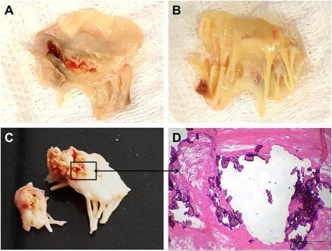 A multi-panel figure illustrating the gross and microscopic pathology of rheumatic heart valve disease (RHVD) in human mitral valves. Panels A and B present clinical photographs of excised mitral valve tissue from a 49-year-old female, showing marked leaflet thickening, retraction, and an opaque, yellowish appearance consistent with chronic fibrosis. Panel A specifically shows focal areas of reddish-dark discoloration, suggesting hemorrhage or tissue damage. Panel C displays gross pathology from a 61-year-old male, highlighting advanced calcification with rigid, cauliflower-like deposits on the valve structure. Panel D is a high-magnification light microscopy image (Hematoxylin and Eosin stain) of the anterior mitral valve leaflet. It demonstrates nodular calcification, appearing as irregular, dark purple hematoxylin-positive deposits embedded within the eosinophilic (pink) fibrotic collagenous matrix. A scale bar of 500 μm is provided. This figure serves as an educational resource for identifying the progression from chronic inflammation and fibrosis to end-stage valvular calcification in rheumatic heart disease.