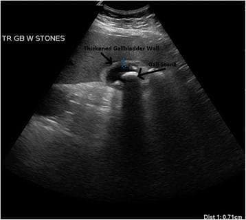 This diagnostic ultrasound image in the transverse plane demonstrates a gallbladder with classic sonographic findings of acute cholecystitis and cholelithiasis. A large, prominent hyperechoic gallstone is visible within the lumen of the gallbladder, exhibiting a characteristic posterior acoustic shadow that extends inferiorly, indicating the dense nature of the calculus. The gallbladder wall is clearly labeled and appears significantly thickened (measuring 0.71 cm as per the distal measurement marker), which is a primary diagnostic criterion for inflammation. Additionally, there is evidence of pericholecystic edema, visualized as a hypoechoic, hazy area surrounding the outer wall of the gallbladder. These features—cholelithiasis, wall thickening, and pericholecystic fluid/edema—collectively support a diagnosis of acute cholecystitis. The image serves as an educational tool for identifying the sonographic hallmarks of biliary disease in a clinical setting.