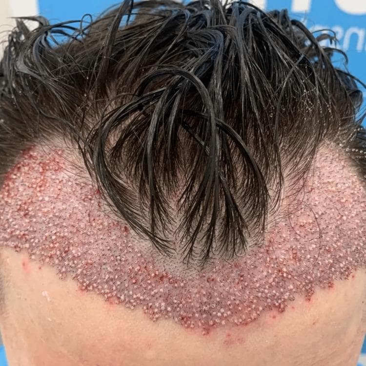 This clinical photograph displays a top-down view of the anterior scalp immediately following a hair transplant procedure. The image focuses on the recipient area, where a new hairline has been established using single follicular units. The transplanted follicles are arranged in a high-density, dotted pattern across the frontal and temporal regions. Visually, the recipient site exhibits characteristic immediate postoperative signs: widespread erythema (pinkish-red coloration) indicative of inflammation and small punctate scabs or micro-incisions at each graft insertion point, creating a rough texture. The patient's existing dark hair is damp and combed forward, partially covering the surgical site. This photograph serves as an educational example of follicular unit transplantation (FUT) or follicular unit extraction (FUE) outcomes, illustrating the immediate surgical manifestation, graft distribution density, and the anatomical reconstruction of the anterior hairline in the treatment of androgenetic alopecia.