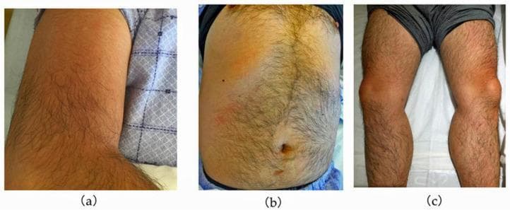 A series of three clinical photographs demonstrating cutaneous manifestations in a patient with dengue fever. (a) Right upper arm showing confluent, blanchable erythema with a diffuse distribution. (b) Anterior trunk (abdomen and chest) displaying a patchy, mottled erythematous rash interspersed with areas of normal skin tone, characteristic of the 'islands of white in a sea of red' pattern often seen in viral exanthems. (c) Lower limbs showing localized, more intense erythema focused around the knees and pretibial regions. The visual findings illustrate the secondary maculopapular rash typical of the recovery or late febrile phase of dengue virus infection. These images serve as an educational resource for identifying the clinical presentation of viral hemorrhagic fever rashes and their variable morphology across different anatomical regions, including the trunk, extremities, and periarticular areas.