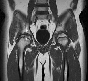 This diagnostic image is a coronal T1 Turbo Spin Echo (TSE) MRI of a pediatric pelvis, illustrating musculoskeletal manifestations of Juvenile Idiopathic Arthritis (JIA). The scan provides a side-by-side comparison of the hip joints. The right hip joint exhibits significant pathological changes, including marked joint space narrowing and prominent bony erosions (indicated by white arrows) on both the superior aspect of the femoral head and the adjacent acetabular margin. These erosions appear as irregular, low-signal intensity focal concavities and lytic lesions that disrupt the smooth cortical contour. In contrast, the left hip joint maintains a relatively preserved joint space and smooth articular surfaces without evidence of bone destruction. The image demonstrates the clinical utility of MRI in detecting late-stage structural damage, such as cartilage loss and erosive disease, which are key indicators of joint destruction in chronic inflammatory arthritis. This content is intended for advanced medical education in pediatric radiology and rheumatology.