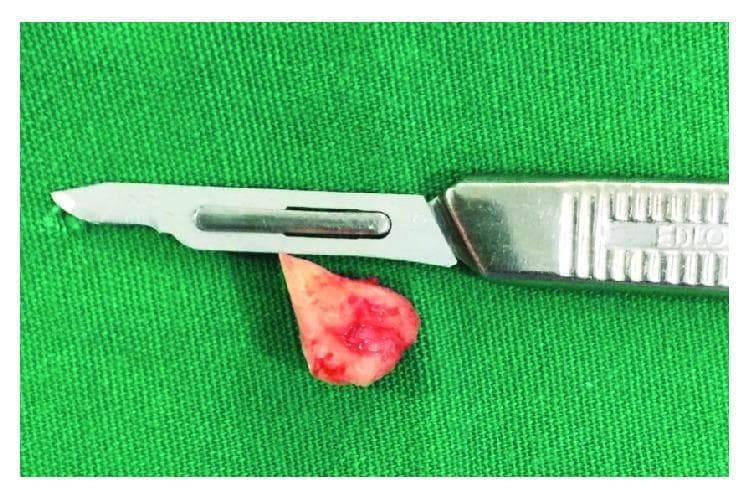 This clinical photograph shows a gross surgical specimen of an extracted mandibular third molar alongside a surgical scalpel, placed on a green sterile surgical drape for size reference. The dental element exhibits a roughly triangular, irregular morphology with a predominant off-white to light pink coloration, interspersed with areas of bright red erythema, consistent with adherent blood and vascularized soft tissue fragments. The scalpel is a standard stainless steel surgical instrument featuring a replaceable blade (likely a #15 or similar small-tip blade) mounted on a textured, ergonomic metallic handle. This visual documents a successful retrieval in a case of iatrogenic displacement of a dental element into the submandibular space. The image is designed for oral and maxillofacial surgery education, illustrating specimen retrieval following extraoral surgical access for the management of intraoperative complications.
