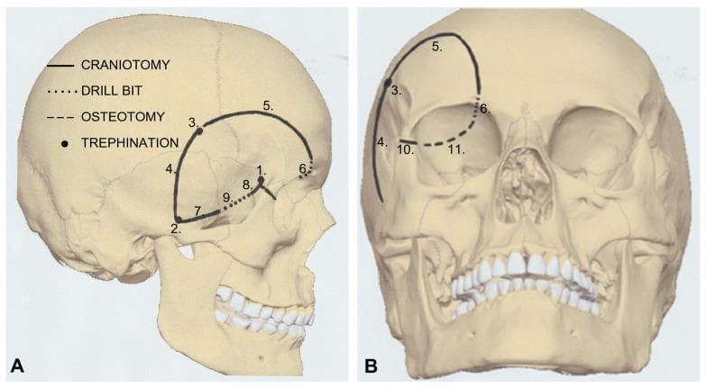 Two-panel anatomical diagram illustrating the bone work sequence for a modified orbitozygomatic (mOZ) one-piece craniotomy on a human skull. Panel A shows a lateral view, while Panel B shows an anteroposterior view. The illustration employs a numbered, coded system to detail surgical steps: trephinations (points 1, 2, 3) at the keyhole, posterior zygomatic arch, and superior temporal line; craniotomy cuts (lines 4, 5, 7, 8, 10) across the temporal, frontal, and sphenoid bones; drill bit maneuvers (dotted lines 6, 8, 9) at the orbital rim and zygomatic area; and osteotomy (dashed line 11) of the orbital roof and superior orbital fissure. This systematic approach facilitates access to the anterior and middle cranial fossae and the superior orbit. The diagram serves as a technical surgical guide for neurosurgical residents and surgeons focusing on skull base approaches for tumors, such as epidermoid cysts, in the superolateral orbital region.