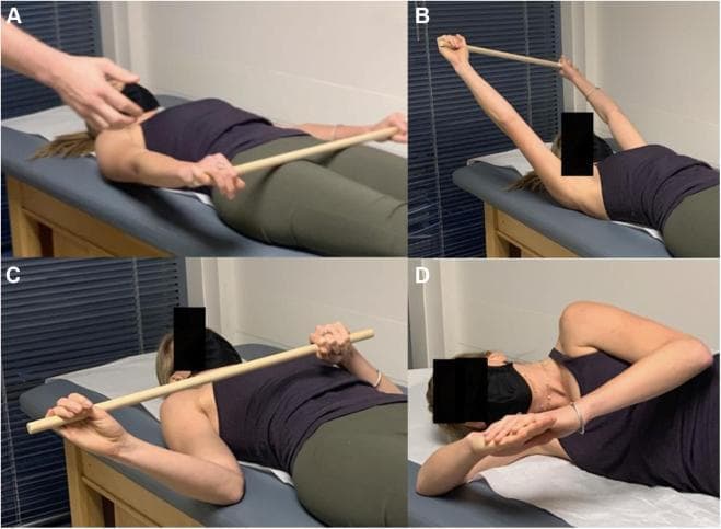 This composite of clinical photographs demonstrates various scapular and shoulder stretching exercises used in the rehabilitation of Pectoralis Minor Syndrome (PMS) and neurogenic thoracic outlet syndrome (NTOS). (A, B) Shoulder flexion stretch: The patient is in a supine position, holding a wooden stick with both hands. This allows the asymptomatic arm to assist the affected arm into maximal overhead flexion, targeting the anterior shoulder and pectoralis minor muscle. (C) External rotation stretch: Also performed supine using a stick, this exercise uses the contralateral arm to facilitate maximal external rotation, stretching the anterior shoulder anatomy. (D) Sleeper stretch: The patient is in a lateral decubitus position (lying on the affected side) with the arm flexed at the elbow. The patient uses the opposite hand to gently push the forearm toward the table, performing passive internal rotation to stretch the posterior shoulder capsule and associated anatomy. These exercises are critical for improving scapular kinematics and relieving neurovascular compression in the retropectoralis minor space.