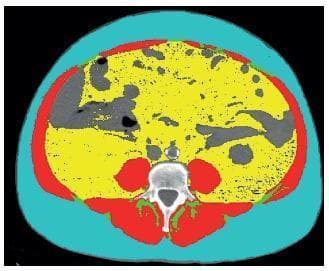 This diagnostic image is an axial CT scan of the abdomen at the L3 vertebral level, processed using sliceOmatic® software for body composition analysis. The image utilizes a pseudocolor segmentation scheme to differentiate tissue types: teal/blue represents subcutaneous adipose tissue (SAT) forming the outer peripheral layer; red indicates skeletal muscle (SM) including the abdominal wall and paraspinal muscles; yellow identifies visceral adipose tissue (VAT) distributed within the abdominal cavity; and green highlights intramuscular adipose tissue (IMAT) located within the muscle boundaries. The L3 vertebral body is visible posteriorly in grayscale. The image serves as an educational tool for quantifying fat and lean mass, often used in clinical research to study metabolic health, obesity, and systemic inflammation (e.g., CRP correlation). The spatial distribution clearly delineates the anatomical boundaries between external fat, the muscular envelope, and internal organ-associated fat.