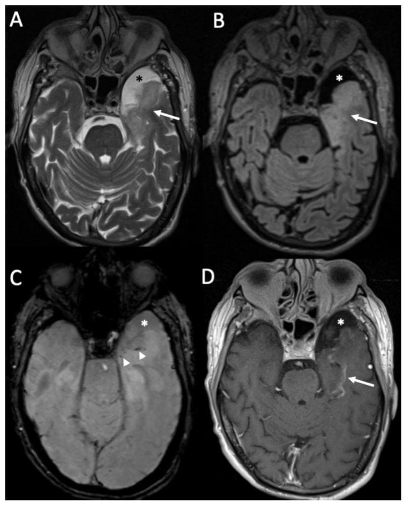 This composite diagnostic image displays four axial MRI views (A-D) of the brain at the level of the midbrain and temporal lobes, illustrating the subacute phase of Herpes Simplex Virus Type 1 (HSV-1) encephalitis. Panel A (T2-weighted) and Panel B (FLAIR) demonstrate significant hyperintensity and swelling within the left temporal lobe (white arrows), characteristic of inflammatory edema. Panel C (Susceptibility-Weighted Imaging, SWI) reveals small, dark punctate areas (white arrowheads) representing hemorrhagic foci, a common complication of necrotizing encephalitis. Panel D (Contrast-enhanced T1-weighted) shows curvilinear leptomeningeal or parenchymal enhancement (white arrow) in the affected temporal region, indicating blood-brain barrier breakdown. Additionally, a well-circumscribed temporo-polar arachnoid cyst is consistently visible across all sequences (asterisk), appearing hyperintense on T2 (A), suppressed on FLAIR (B), and following CSF signal intensity on SWI (C) and T1 (D). These findings emphasize the classic limbic system involvement and hemorrhagic potential of HSV encephalitis.