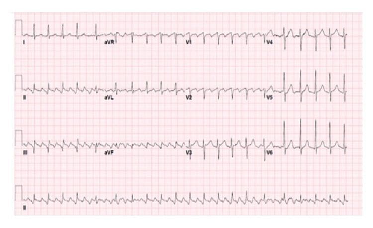 A 12-lead electrocardiogram (ECG) demonstrating typical atrial flutter with variable atrioventricular (AV) block. The tracing shows a classic 'sawtooth' baseline pattern, most prominent in the inferior leads (II, III, and aVF), representing rapid, regular macro-reentrant atrial activity (F-waves). The ventricular response (QRS complexes) is irregularly irregular because the AV node conducts atrial impulses at varying ratios (e.g., 2:1, 3:1, or 4:1 conduction). This diagnostic image is a key educational resource for cardiology, illustrating the distinction between atrial flutter and atrial fibrillation through the presence of organized, repetitive atrial waveforms. The QRS complexes appear narrow, indicating normal intraventricular conduction. This ECG provides a clinical example of supraventricular tachycardia and the importance of identifying baseline atrial morphology when assessing irregular rhythms.