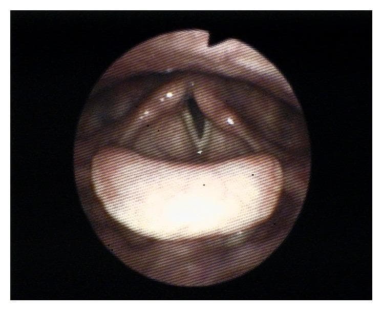 This diagnostic fiberoptic laryngoscopy image provides a superior view of the larynx during attempted phonation. The primary finding is unilateral left vocal cord paralysis. While the right vocal cord appropriately adducts toward the midline, the left vocal cord remains fixed in a more lateral, paramedian position. This asymmetry results in an incomplete glottic closure, manifesting as a visible V-shaped gap (glottal insufficiency) between the true vocal folds. Anatomical landmarks include the epiglottis in the foreground, the false vocal folds, and the arytenoid cartilages posteriorly. The left vocal fold appears relatively flaccid and lacks the tension seen on the contralateral side. This clinical finding is characteristic of recurrent laryngeal nerve neuropraxia or injury, typically presenting with symptoms of dysphonia or hoarseness due to the air leak during phonatory efforts.