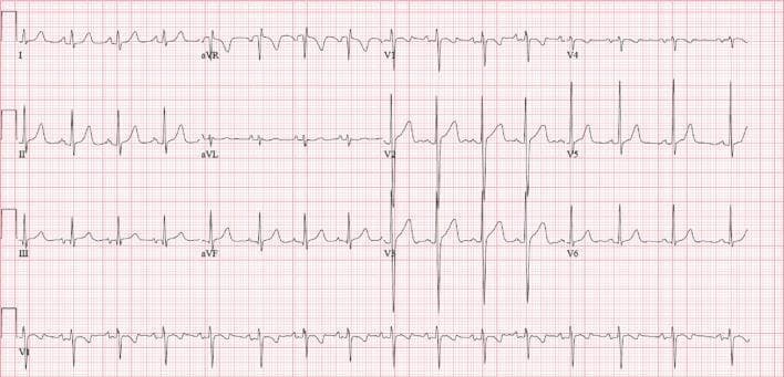 A standard 12-lead electrocardiogram (ECG) recorded at a paper speed of 25 mm/s. The tracing shows a normal sinus rhythm with notable atrial and ventricular repolarization abnormalities. The P waves in lead II demonstrate a notched or 'M-shaped' morphology (P-mitrale), while the P wave in lead V1 is prominently biphasic with a deep terminal negative component, both characteristic of left atrial enlargement. There is evidence of significant T-wave inversions across the precordial leads, specifically from V2 through V6, as well as in the inferior leads III and aVF. The QRS complexes appear to have normal voltage and duration, and the PR interval is within normal limits. This diagnostic image illustrates the electrical manifestations of structural heart changes, specifically left atrial pathology and diffuse repolarization abnormalities, commonly associated with conditions causing chronic pressure or volume overload.