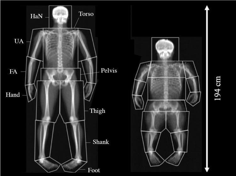 This diagnostic image shows a side-by-side comparison of two whole-body Dual-energy X-ray Absorptiometry (DEXA) scans, highlighting body composition and skeletal morphology in a control subject (left) and an individual with achondroplasia (right). Both scans utilize a standardized 15-segment analysis model, with boundaries demarcated by geometric shapes (squares, rhomboids, and pentagons) along the transverse axis of the joints. Segments are labeled as Head and Neck (HaN), Torso, Pelvis, Upper Arm (UA), Forearm (FA), Hand, Thigh, Shank, and Foot. The achondroplasia scan demonstrates characteristic disproportionate dwarfism, including rhizomelic shortening of the long bones (UA and Thigh), a macrocephalic head appearance relative to body size, and a significantly reduced overall height compared to the control. The segmental analysis is used in clinical research to quantify differences in bone mineral content (BMC), bone mineral density (BMD), and soft tissue distribution between the two phenotypes. The image serves as a clinical illustration of skeletal dysplasia and the application of DEXA for detailed anthropometric and volumetric bone mineral density assessment.