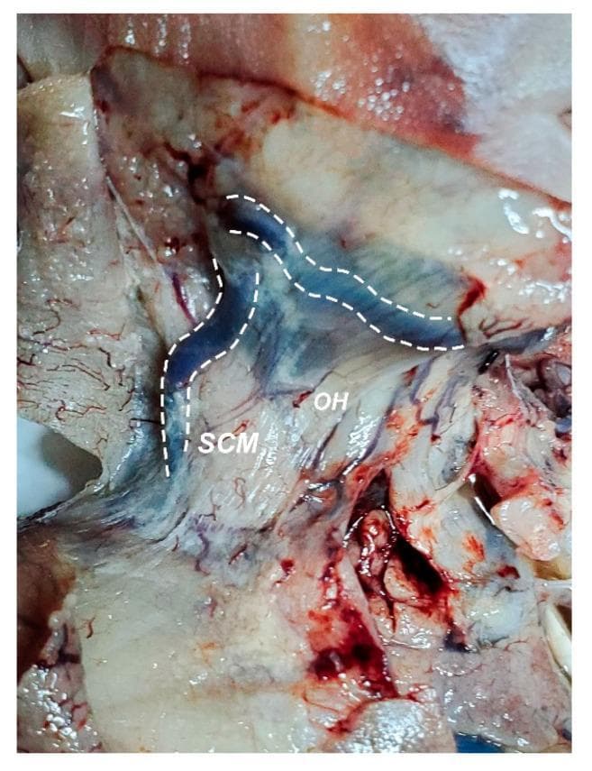 This clinical photograph shows a gross dissection of the right side of the neck in a fetal or neonatal specimen, highlighting venous abnormalities. The skin has been removed to reveal the underlying anatomy through the semi-transparent platysma muscle. Two prominent, dilated venous structures are outlined with dashed white lines: the linguo-facial trunk (vein), which follows a horizontal, sinuous course toward the mandible, and the external jugular vein, which descends vertically. Key muscular landmarks are labeled, including the sternocleidomastoid muscle (SCM) positioned laterally and the omohyoid muscle (OH) located medially. A distinct bluish coloration in the carotid triangle area indicates significant dilation of the underlying internal jugular vein. The educational focus is on the clinical presentation of cervical venous distension and its relationship to neighboring muscular structures. This specimen demonstrates a case where the linguo-facial and external jugular veins are markedly increased in caliber, reflecting potential systemic vascular congestion or congenital anomalies.
