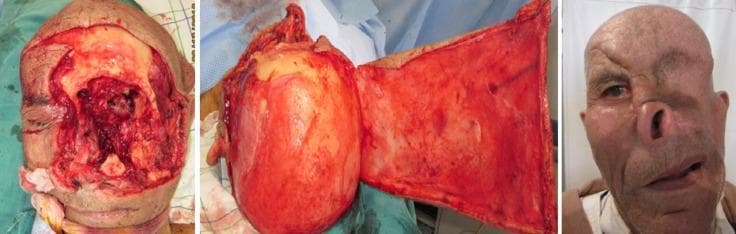 A three-panel clinical progression series demonstrating facial reconstructive surgery for a Type IV orbital-facial defect. The left panel shows the intraoperative state following an orbital exenteration and extensive tumor resection, resulting in a large, raw surgical cavity involving the left mid-face, forehead, and cheek with exposed deep tissue and irregular margins. The center panel illustrates the surgical technique, showing a large Converse scalping flap being prepared and mobilized for transposition; the flap consists of a substantial portion of the scalp and forehead skin. The right panel displays the post-operative outcome at a 2-year follow-up. The scalp flap successfully covers the primary defect, although significant facial asymmetry remains. Key features include the absence of the left eye, displacement and distortion of the nose and upper lip, and different skin texture/pigmentation between the donor flap and the native facial skin. This series illustrates complex maxillofacial reconstruction following oncological resection in the head and neck specialty.