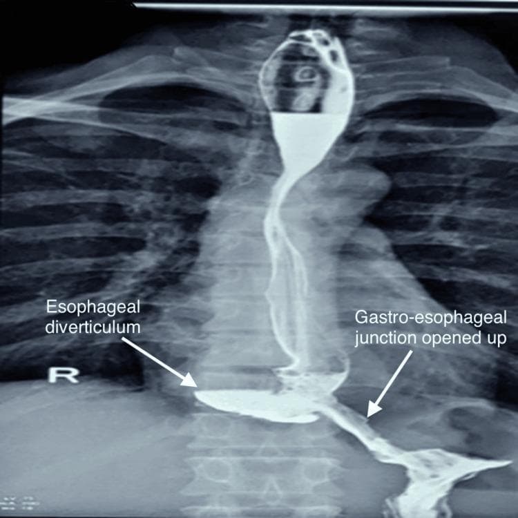 Postoperative barium swallow study (upper gastrointestinal contrast radiography) demonstrating the distal esophagus and gastro-esophageal junction (GEJ). The image shows the esophagus opacified with radiopaque contrast agent, revealing a significant out-pouching on the right posterior aspect labeled as an 'Esophageal diverticulum' (specifically an epiphrenic diverticulum). This diverticulum is well-defined and filled with contrast, communicating with the esophageal lumen. Distal to the diverticulum, the GEJ is clearly visualized and labeled as 'opened up', indicating surgical patency (post-Heller’s cardiomyotomy). Contrast is seen flowing smoothly through the junction into the stomach without evidence of luminal narrowing, stricture, stenosis, or extravasation. The contrast boundaries are sharp, suggesting preserved mucosal integrity and no postoperative leakage. This diagnostic image illustrates the successful management of esophageal motility disorders or structural abnormalities, confirming appropriate bolus transit into the gastric cardia.
