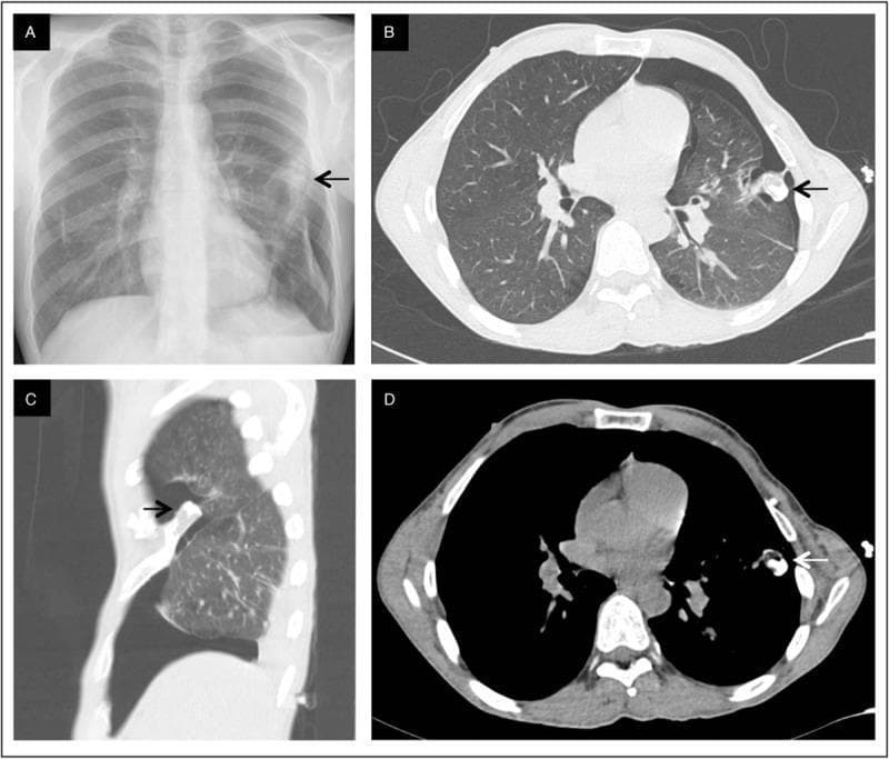 This composite figure presents a radiographic and tomographic evaluation of a 32-year-old male with spontaneous pneumothorax and hereditary multiple exostoses (HME). Panel A is a posteroanterior (PA) chest X-ray demonstrating a left-sided pneumothorax, characterized by a visible visceral pleural line and peripheral radiolucency with absent lung markings. A focal opacity is noted near the left fifth rib. Panels B-D provide axial (B, D) and sagittal (C) CT imaging of the chest. The axial lung window (B) confirms the left pneumothorax and reveals underlying apical paraseptal emphysema. The bone and soft tissue windows (C, D) highlight a prominent intrathoracic rib exostosis (osteochondroma) arising from the anterior arch of the left fifth rib (black and white arrows). The sagittal reconstruction (C) clearly shows the bony protrusion extending into the pleural space, making direct contact with the collapsed lung parenchyma. This suggests a mechanical etiology for the pneumothorax related to the costal exostosis. Target audience: medical students and radiologists.