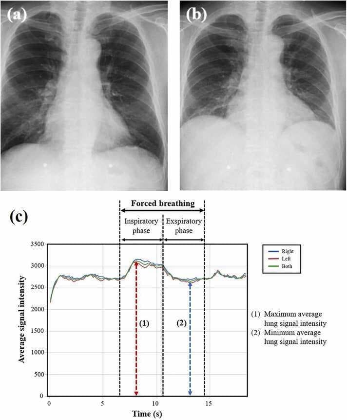 This composite educational material demonstrates Dynamic Digital Radiography (DDR) findings in a 75-year-old male with mild COPD. (a) Posterior-anterior (PA) chest radiograph during forced inspiration shows increased lung volume, wider intercostal spaces, and a depressed diaphragm, corresponding to maximum lung signal intensity (SImax = 3113.7). (b) PA chest radiograph during forced expiration shows decreased lung volume and elevated diaphragm position, corresponding to minimum signal intensity (SImin = 2635.0). (c) A temporal graph plots average lung signal intensity over 20 seconds of breathing. The 'Forced breathing' segment is subdivided into an 'Inspiratory phase'—where signal intensity rises to a peak at approximately 8 seconds (1)—and an 'Expiratory phase'—where intensity falls to a trough at approximately 14 seconds (2). Separate lines track the right, left, and combined lung intensities. This visual illustrates how DDR quantifies ventilatory function by tracking changes in radiographic density (signal intensity) as air volume fluctuates, providing a dynamic assessment of obstructive lung disease.