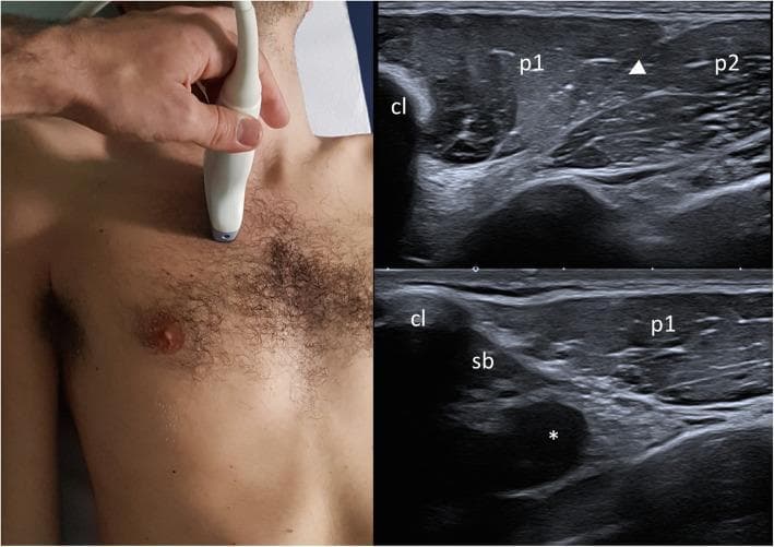 This composite educational resource consists of a clinical photograph showing ultrasound probe placement and two corresponding musculoskeletal ultrasound images of the infraclavicular region. The clinical photograph demonstrates a sagittal parasternal probe orientation with the cranial edge on the clavicle. The ultrasound images (top and bottom right) provide a sagittal view of the chest wall anatomy. Key landmarks include the hyperechoic clavicle (cl) with posterior acoustic shadowing. Originating from the clavicle is the clavicular head of the pectoralis major muscle (p1). A distinct hyperechoic cleavage plane (arrowhead) separates p1 from the sterno-costal head of the pectoralis major (p2). Deep to the clavicle, the subclavius muscle (sb) is visualized. Further deep to these muscular layers, the axillary artery (*) appears as an anechoic circular structure, adjacent to the axillary vein and components of the brachial plexus. This visual sequence is used in medical education to teach standard ultrasound screening protocols for assessing pectoralis muscle integrity, particularly in diagnosing congenital anomalies such as Poland Syndrome.