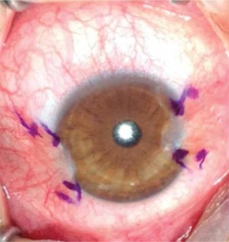 This clinical photograph displays a close-up view of a human eye with double pterygium, showing fibrovascular proliferations on both the nasal and temporal sides of the bulbar conjunctiva. The pterygia extend across the limbus and onto the peripheral corneal surface, creating visible irregularities in corneal contour. To delineate the surgical margins for excision and grafting, the lesions have been marked with a purple sterile surgical pen. The surrounding bulbar conjunctiva exhibits significant injection (redness) and prominent vascularity. The central cornea remains relatively transparent, allowing for visualization of the brown iris and the pupil, which shows a central light reflex. This image serves as a preoperative educational example of surgical planning for pterygium excision and conjunctival autografting.