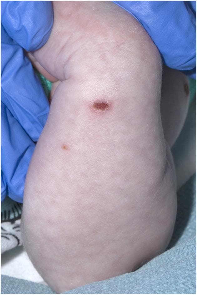 This clinical photograph displays skin lesions on the arm of a 21-day-old neonate, characteristic of the healing phase of varicella-zoster virus (VZV) infection. The primary finding is a centrally located, oval, crusted lesion showing a thick, dark-reddish-brown scab, indicating a dried vesicle or pustule. A second, smaller, and flatter brownish papule is visible proximally. The surrounding skin exhibits 'cutis marmorata,' a reticulated or mottled vascular pattern commonly seen in neonates due to vasomotor instability, but also noted here in the clinical context of neonatal varicella. No significant surrounding erythema or edema is observed at this stage of the lesions. This image serves as a pedagogical example of neonatal dermatology and the clinical progression of viral exanthems from vesicular to crusted stages. The presence of blue medical gloves indicates a clinical examination setting.