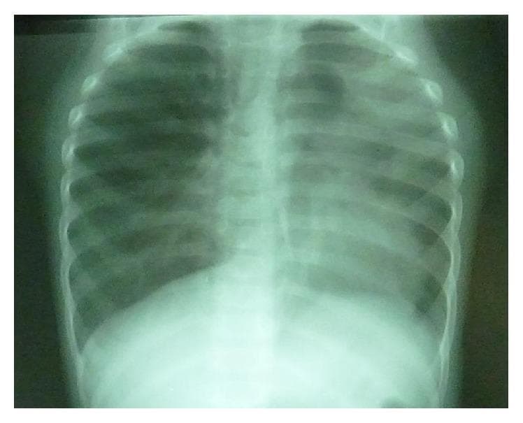Anteroposterior (AP) chest X-ray of a pediatric patient demonstrating significant pulmonary asymmetry and mediastinal displacement. The left upper lung field shows increased opacity and volume loss, characteristic of a left upper lobe collapse (atelectasis). This is associated with an ipsilateral mediastinal shift, visible by the deviation of the tracheal air column and cardiac silhouette toward the left side of the thoracic cavity. In contrast, the right lung field appears markedly more radiolucent with increased volume, representing compensatory hyperinflation of the contralateral lung. These diagnostic findings are critical for identifying obstructive lung processes, such as follicular bronchiolitis or foreign body aspiration, which lead to differential ventilation and volume loss in the affected segments. The image serves as a clinical example of the secondary effects of focal lung collapse on thoracic anatomy and mediastinal positioning.