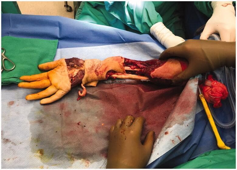 This operative photograph demonstrates the surgical 'filleting' of a right hand and forearm for the creation of a pedicled fillet flap. The image shows a transverse incision across the level of the metacarpal heads, with the soft tissue envelope (skin and subcutaneous fat) being dissected away from the underlying skeletal and deep muscular structures. Visible anatomical components include the exposed metacarpal bones, intrinsic hand musculature (interossei), and the distal radius and ulna of the forearm. A large section of the soft tissue remains connected proximally, revealing the underlying bone and deep forearm musculature. The purpose of this technique is to harvest a neurovascularly intact soft tissue flap from a non-salvageable distal extremity to provide coverage for a proximal amputation stump. The procedure highlights principles of orthopaedic oncology and reconstructive plastic surgery, specifically the use of spare parts for wound closure.